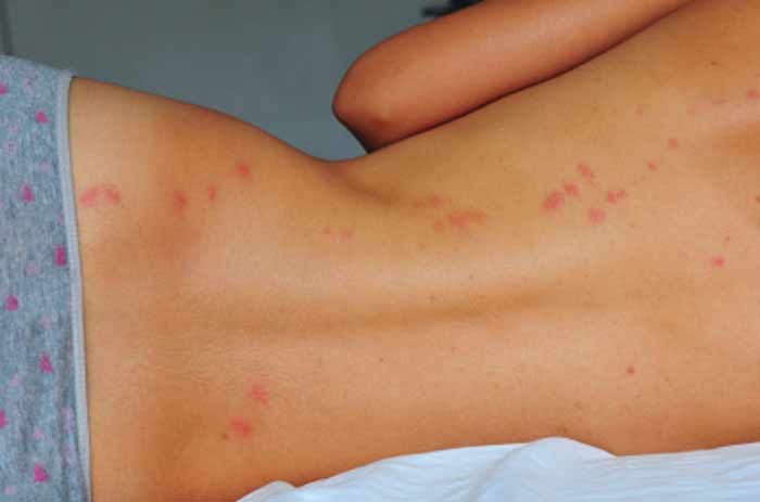 Bed bug Bites dangers & allergies