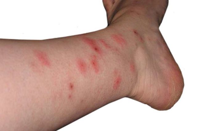 How Long Do Bedbug Bites Take To Heal