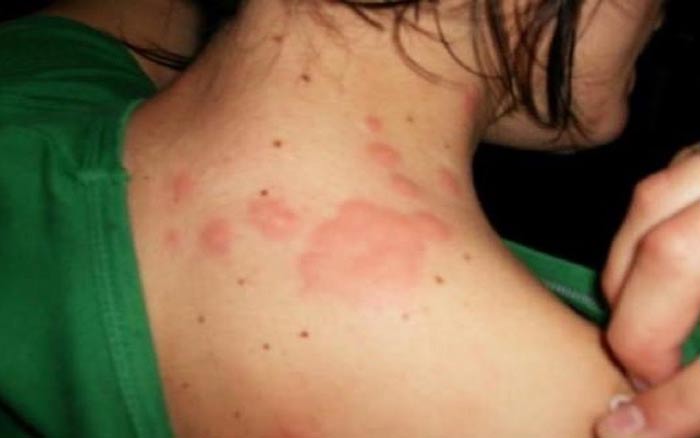bites from bed bugs image