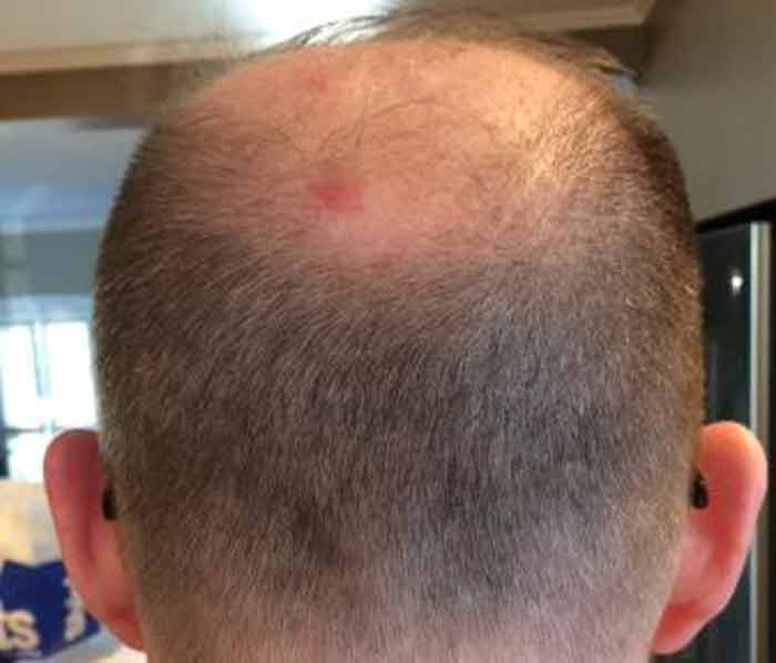 bed bug bite scalp picture