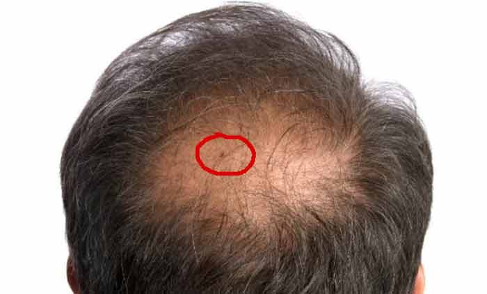 Dealing with bed bugs in hair-Symptoms & treatment