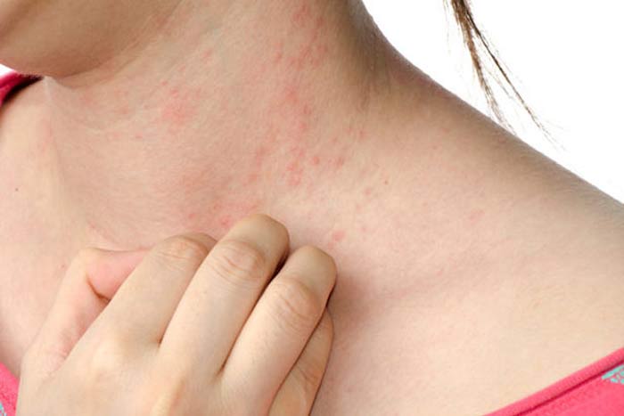 dust mite allergy rash symptoms and treatment