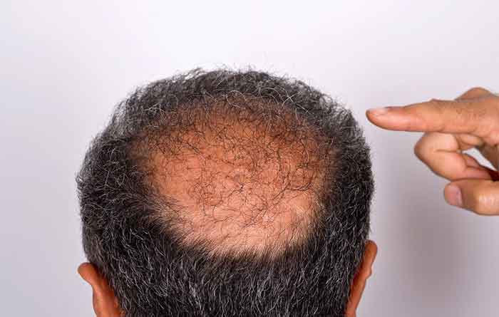 Do dust mites lead to hair loss