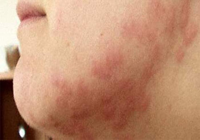 Photo of dust mite bite rash on human face skin