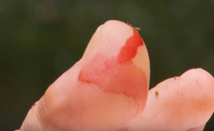 Toe bitten by water bug image